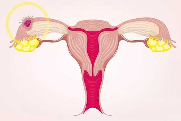 西安有资质的代孕公司,子宫肌瘤会影响到试管婴儿成功率嘛?-西安供卵试管费用